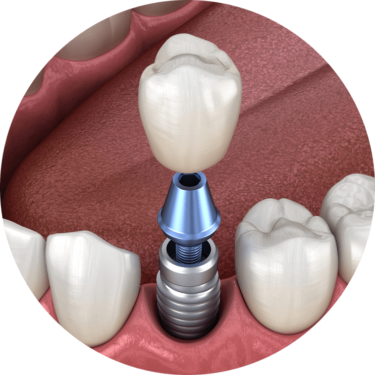 Model of single implant showing implant, abutment and crown.