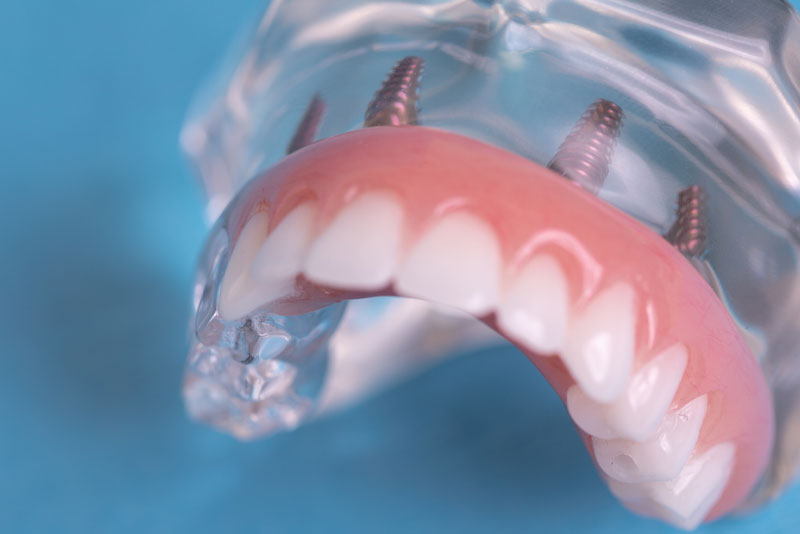 Model of full arch all-on-4 dental implant model with lower arch zirconia prosthesis attached.