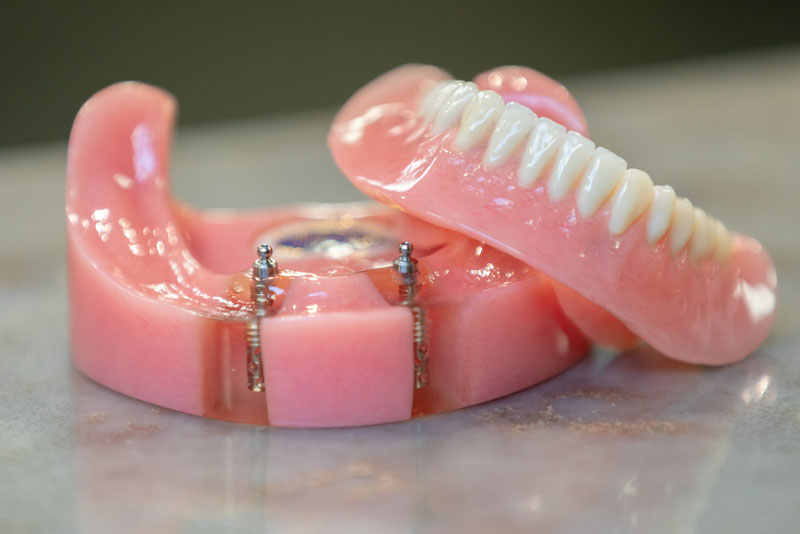 implant supported dentures model