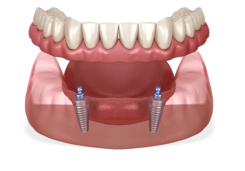 Model of lower full arch snap-on implant supported denture hovering over 2 dental implants.
