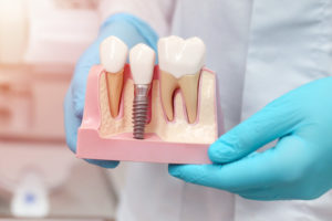 Doctor in scrubs holding a single dental implant model