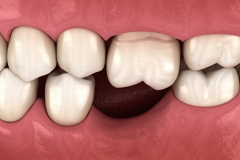 Model showing molar teeth shift due to missing teeth.