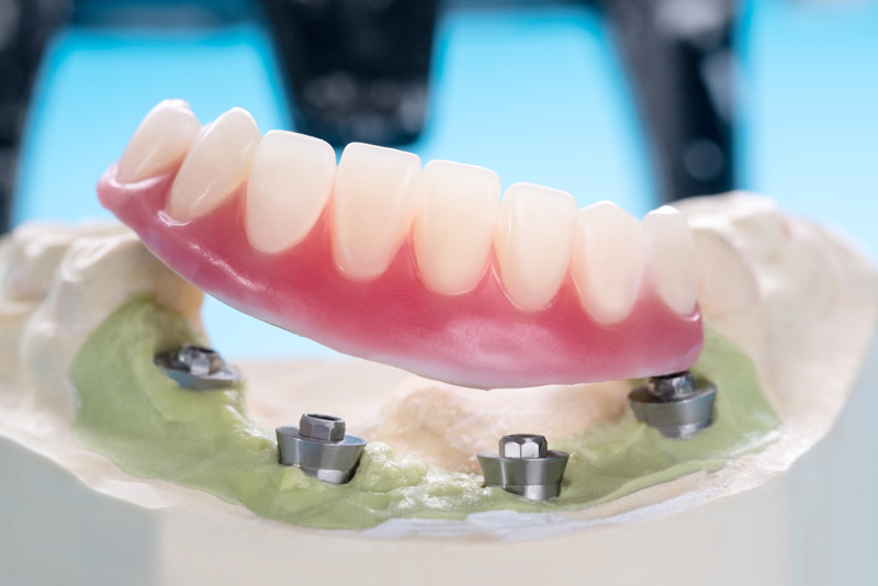 Model of a lower full arch prosthesis floating over an all-on-4 dental implant model