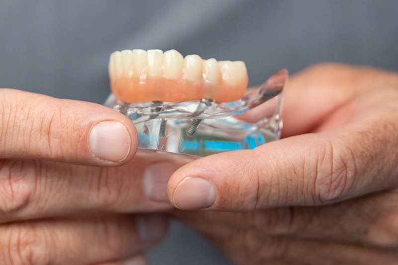 Male hands holding model of a full arch dental prosthesis attached to all-on-4 dental implant model