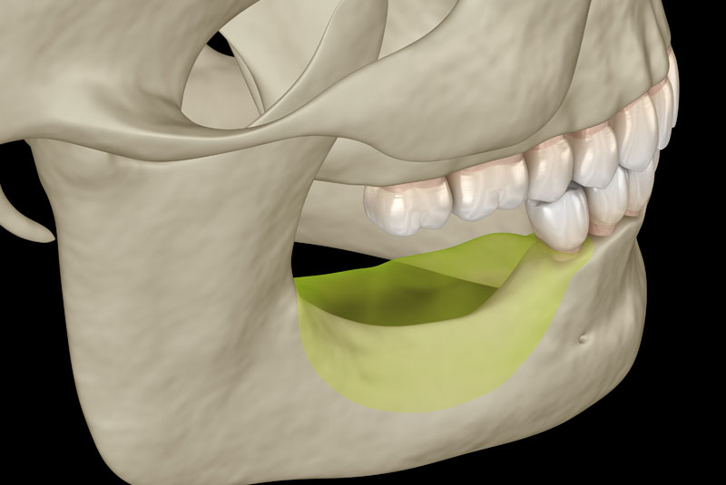 jaw bone loss graphic 1 1 - Dr. Tim Silegy OMFS