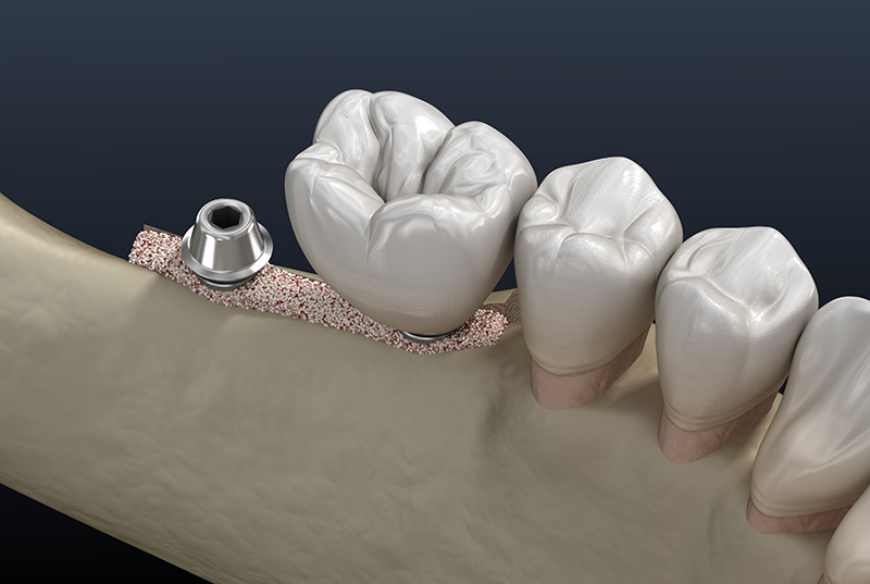 Model of 2 dental implants attached to a jawbone after ridge preservation bone grafting.