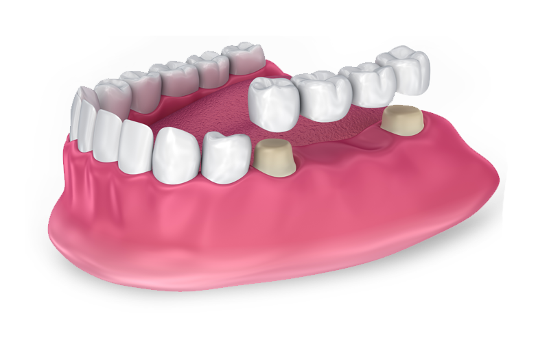 Model of lower arch of teeth with a 4 implant crown bridge to be attached to adjacent teeth.
