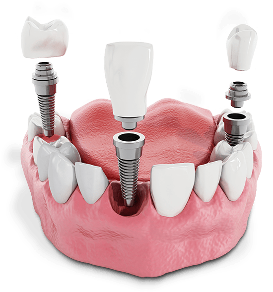Model of lower arch with multiple dental implants in anterior and posterior locations.
