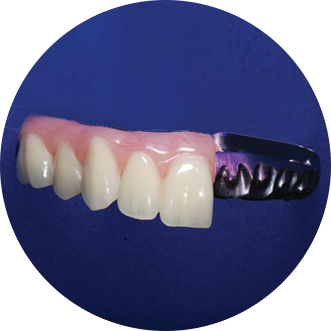 Traditional Acrylic implants