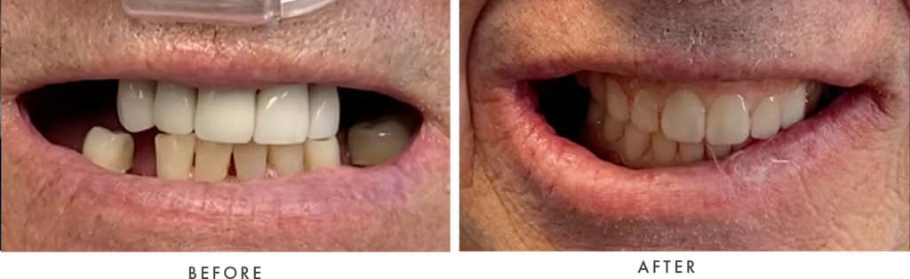 Dental Implant patient - before and after