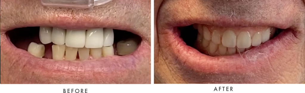 Dental Implant patient - before and after