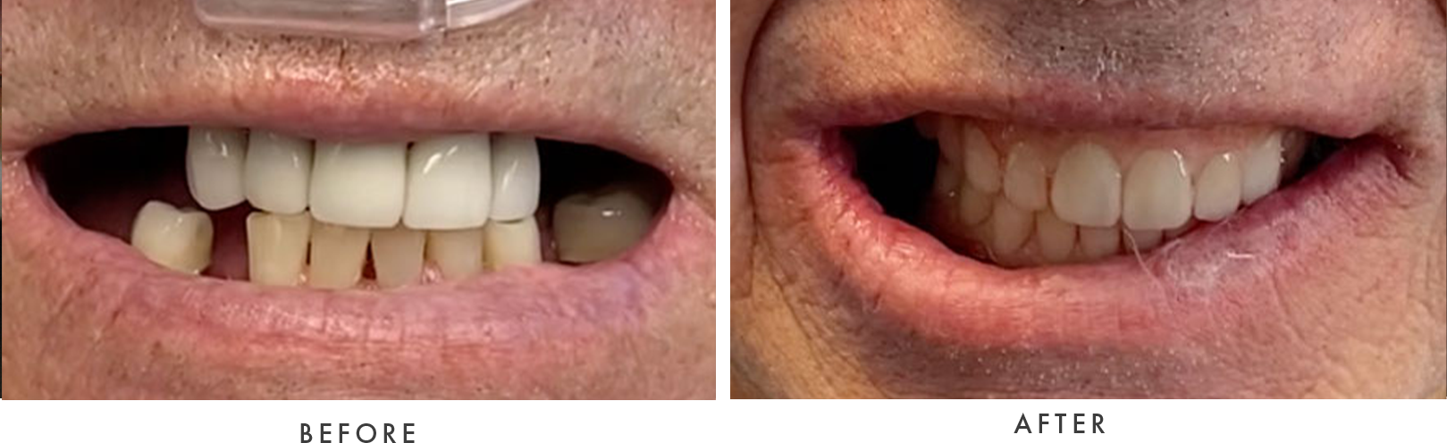 Dental Implant patient - before and after