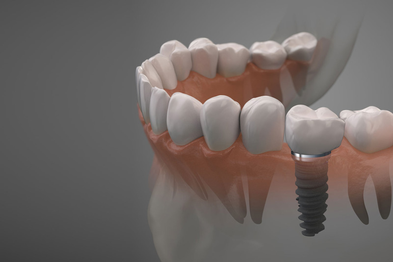 General Extractions upgrade