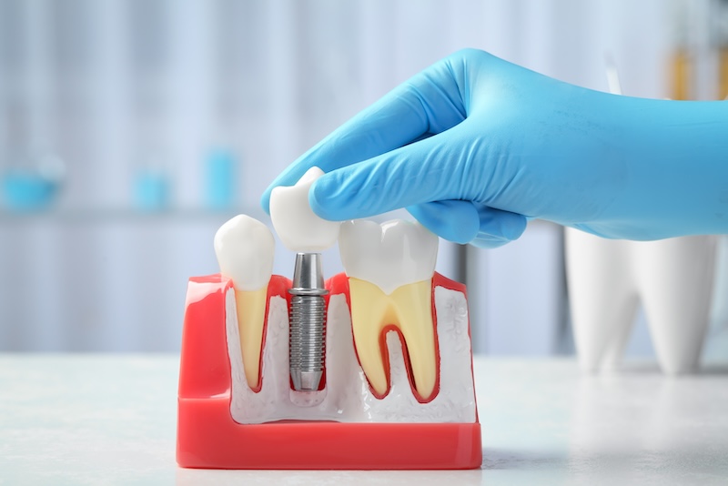 Dental Implants: The Pros and Cons You Need to Know