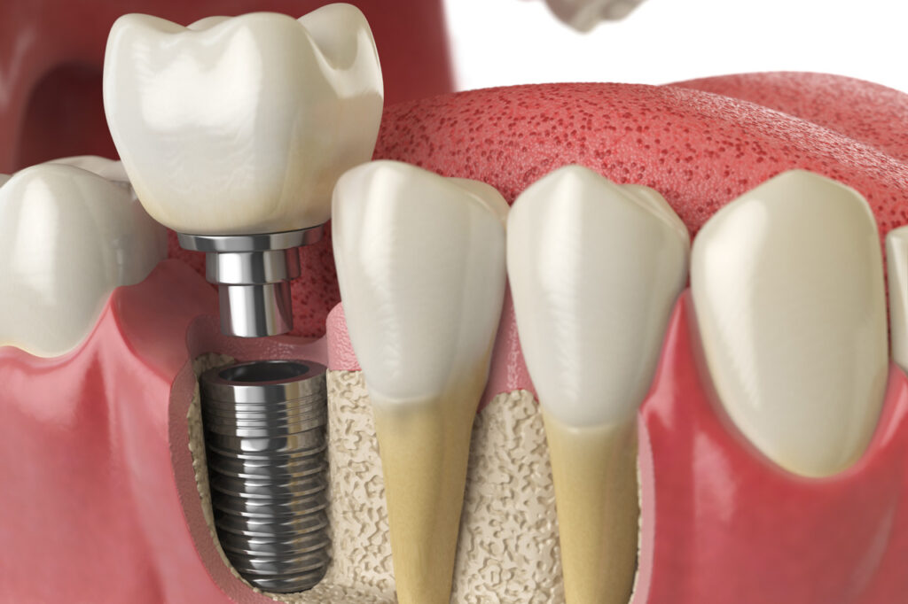 dental implants
