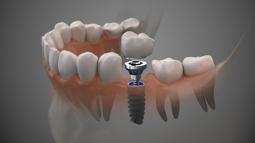 Tooth human implant. On1 concept. Dental prosthetic innovation.